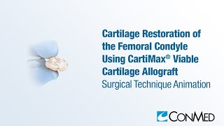 Cartilage Restoration of the Femoral Condyle Using CartiMax®  CONMED Animation [upl. by Anitnas]