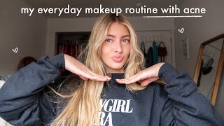 my everyday makeup routine with acne while on accutane [upl. by Enirehtac]