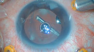 Vitrectomy to Remove Retained Lens Fragments  Posterior Capsular Rupture  Cataract Surgery [upl. by Deery415]