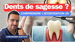 Comprendre l’Extraction DENTS DE SAGESSE [upl. by Durman]