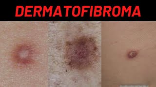 Dermatofibroma Causes Symptoms What is it How is it treated Benign Fibrous Histiocytoma [upl. by Ednyl]