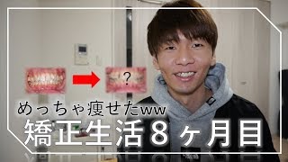 8ヶ月間歯列矯正した経過と感想を語ります。 [upl. by Hephzipa]