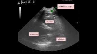 Peritoneopericardial Diaphragmatic Hernia PPDH [upl. by Gagliano]