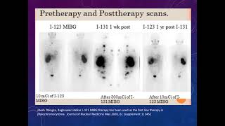 Imaging in neuroendocrine tumor [upl. by Ariam931]