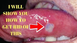 how to get rid of canker sores on tongue canker sores in mouth treatment [upl. by Duquette255]