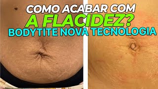 COMO ACABAR COM A FLACIDEZ I 5 COISAS DO BODYTITE QUE VOCÊ PRECISA SABER  CIRURGIA PLASTICA [upl. by Stier]