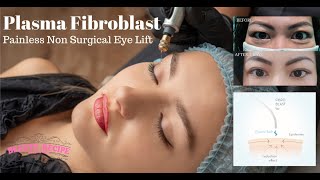 Plasma Fibroblast Non Surgical Blepharoplasty Eyelift Treatment amp Training Singapore [upl. by Faydra]