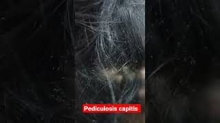 Pediculosis extreme  very severe head lice infestation shorts [upl. by Sato289]