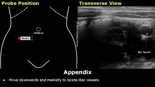 GI Imaging  Hepatic Steatosis and Cirrhosis [upl. by Nyvek]