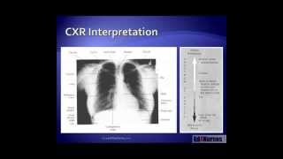 5 Steps to Chest Xray Interpretation [upl. by Sven796]