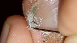 How to clean in depth lateral toenail fold 10 [upl. by Ahen]