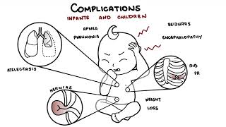 What is Pertussis and whooping cough  Bordetella pertussis symptoms pathophysiology and treatment [upl. by Whall110]