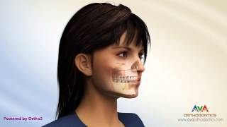 Surgical Orthodontic Treatment  Different Procedures [upl. by Infield238]