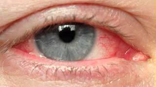 Eye cancer symptoms [upl. by Yerffoeg640]