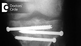 What is the effect of MRI on Internal Fixation Implants  Dr Mohan M R [upl. by Chlori]