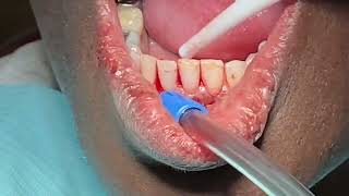 ApicoectomyEndodontic Secondary InfectionHow To Approach [upl. by Nosraep95]