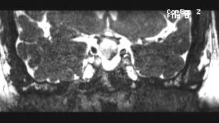 Craniopharyngioma adamantinomatous [upl. by Sigrid]