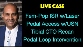 LIVE CASE FemPop ISR Pedal Access and Tibial amp Pedal Loop Intervention [upl. by Alekram547]