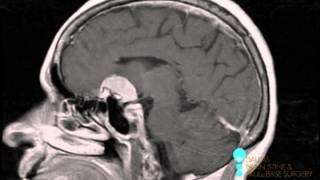 What is a meningioma [upl. by Porcia420]