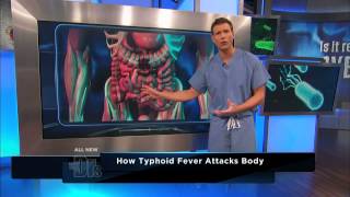 How Typhoid Fever Affects the Body  The Doctors [upl. by Adamec834]