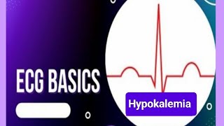 ECG changes in Hypokalemia Causes of Hypokalemia [upl. by Narut]