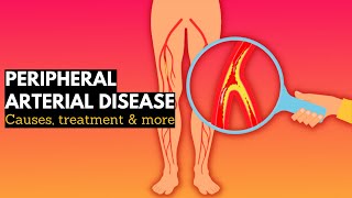 Peripheral vascular disease Causes Signs and Symptoms Diagnosis and Treatment [upl. by Llennhoj]