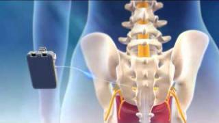 Overview of Sacral Nerve Stimulation for Urinary Control [upl. by Janeva]