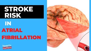 Atrial Fibrillation AF and the Risk of Stroke [upl. by Gaynor]