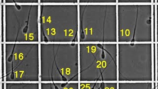 Sperms counting by Neubauer chamber  Sperms counting formula [upl. by Holna]