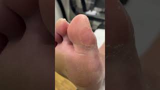 Say goodbye to hard skin Watch this foot transformation by a podiatrist FootCare PodiatryExperts [upl. by Gosney]