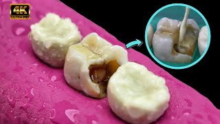 INCREIBLE caries entre los dientes tratamiento  Endodoncia  Resina compueta 4k [upl. by Idram215]