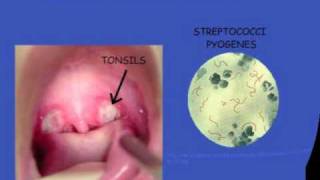 Streptococcal pharyngitis [upl. by Shamus]