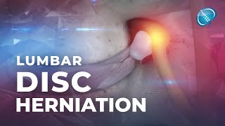 What is Lumbar Disc Herniation  Herniated Disc [upl. by Saimerej]