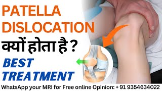 Patella Subluxation Dislocation क्यों होता है  MPFL Injury Causes amp Best Treatment [upl. by Nyre]