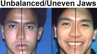 Orthodontic Treatment of Asymmetrical Unbalanced Disproportionate or Unequal Jaw by Dr Mike Mew [upl. by Ardnosac]