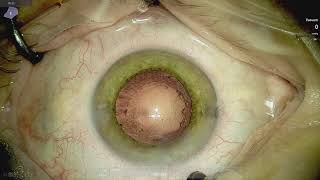 Intumescent white cataract Lukan Mishev live stream [upl. by Ocana]