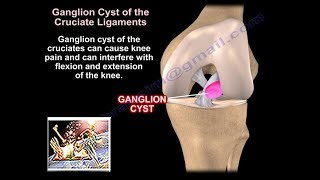 Ganglion Cysts Around The Knee  Everything You Need To Know  Dr Nabil Ebraheim [upl. by Shwalb429]