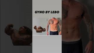 GYNECOMASTIA SURGERY AND BEYOND [upl. by Reynold]