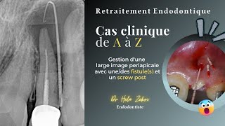 Retraitement endodontique Cas Clinique de A à Z fistule screw post obturation et controle [upl. by Priestley]