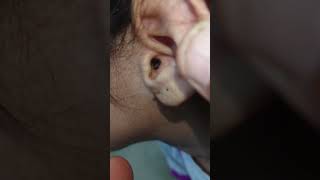 otitis externa with ear wax [upl. by Norword]