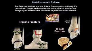 Ankle Fractures In Children  Everything You Need To Know  Dr Nabil Ebraheim [upl. by Vena813]