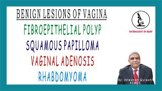 Benign Lesions of Vagina Female Genital Tract [upl. by Eenahc200]