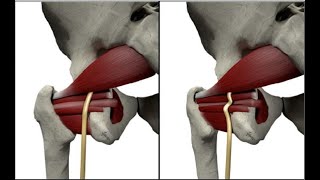 parasacral sciatic nerve block  casals approach block [upl. by Sudhir]