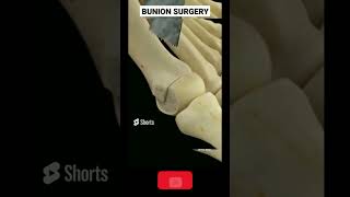 BUNION bunion treatment buniontoe bunion [upl. by Enomsed]