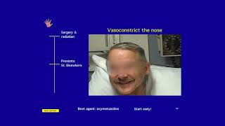 Awake Intubation Made Easy from AOD [upl. by Ericksen314]