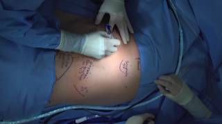 Technique for Chest Tube Insertion [upl. by Ferdinanda996]