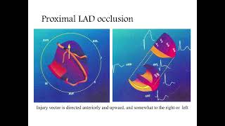 Localizing the culprit artery blockage in patients experiencing a STEMI ECG analysis  MI [upl. by Toy614]