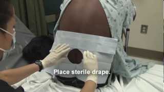 Adult Spinal Tap Procedure Video [upl. by Melodie]