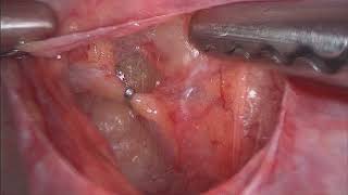 Uterine Artery Ligation Clipping  Anterior and Posterior Approach [upl. by Lenroc]