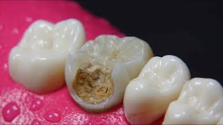 INCREIBLE dentista reconstruye diente dañado por caries Endodoncia  resina en 4K [upl. by Aknayirp]